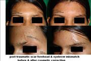 Before After Pictures,Cosmetic surgery,Delhi, scar removal 